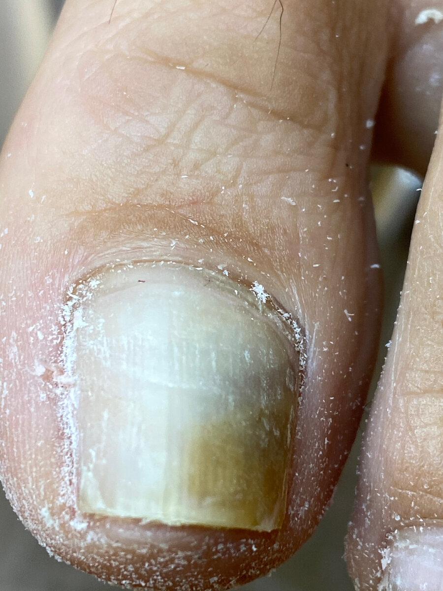 Почему появляются белые пятна на ногтях и что с этим делать