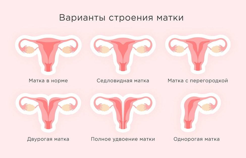 Что такое перегородка в матке ?