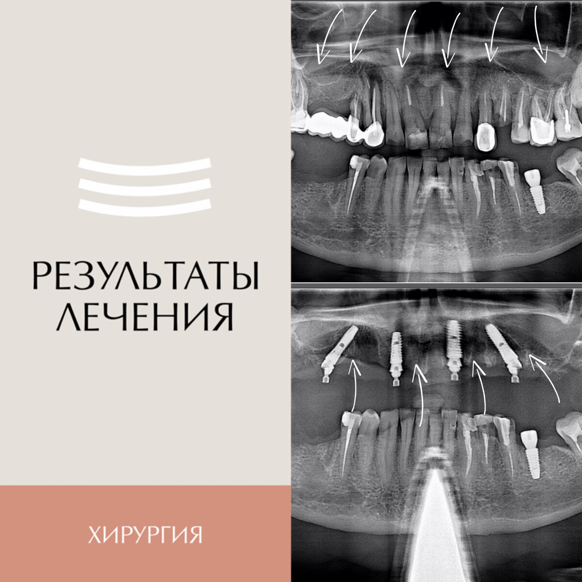 Результаты протезирования на имплантатах верхней челюсти