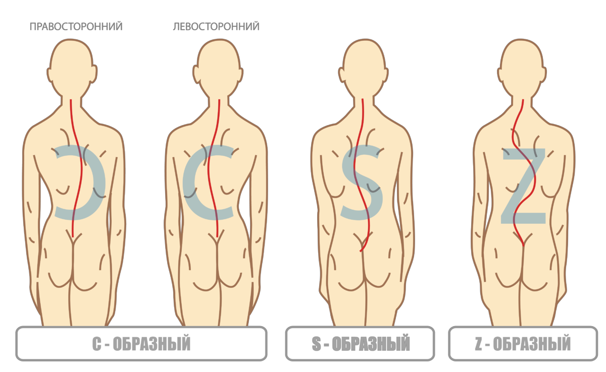 Кифотическая деформация грудного отдела позвоночника