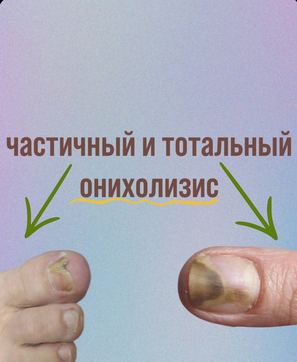 Онихолизис бывает частичным или тотальным.
