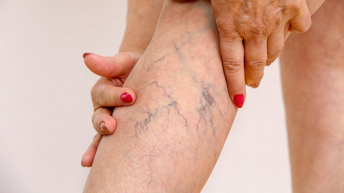 Лечение сосудов. Ретикулярный варикоз