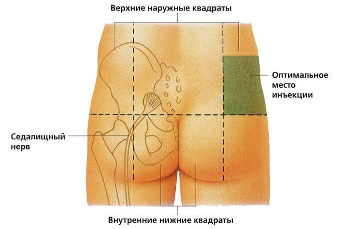 Как Правильно Сделать Укол В Ягодицу В Домашних Условиях.