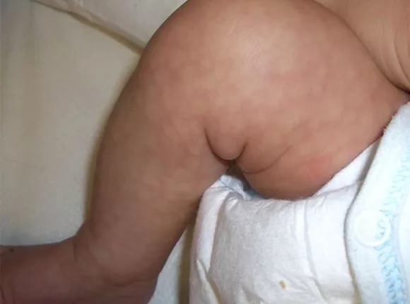 синдром Книппеля-Трипане — это внутриутробная патология, начинающая интенсивное развитие сразу после рождения. Заподозрить явление можно по удлиненным конечностям или пигментации на кожных покровах;  Определить детский варикоз по фото, можно, если у малыша присутствует сосудистая сетка