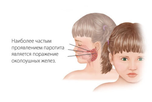 Паротит (свинка) у детей — Into-Sana