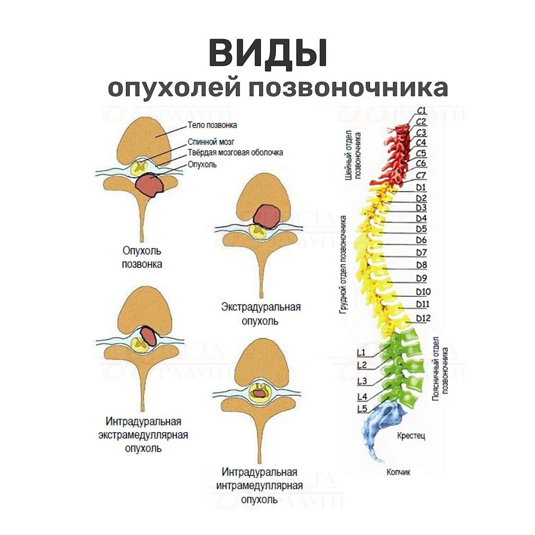 Опухоль позвоночника