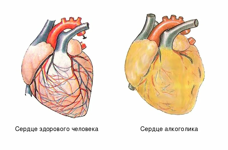 Влияние на сердечно сосудистую систему. Влияние алкоголя на сердечно-сосудистую систему. Сердце здорового человека и сердце алкоголика.