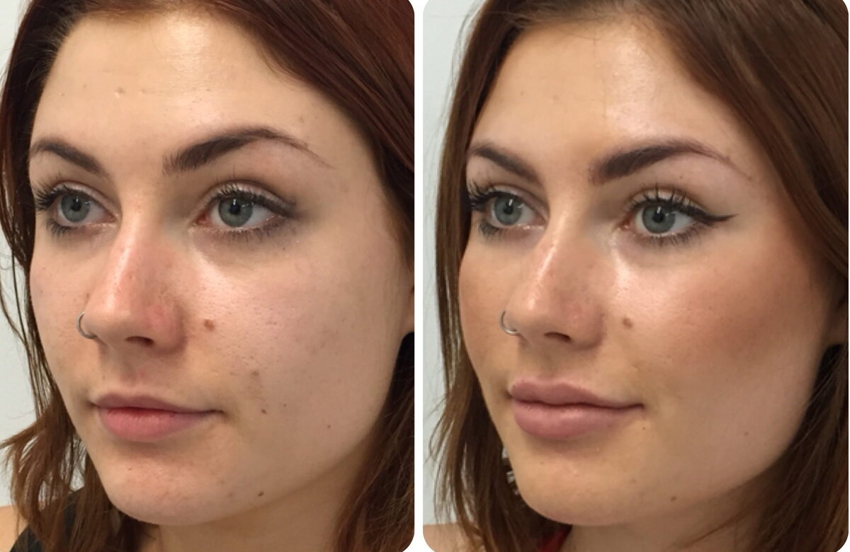 Как ставят филлеры. Контурная пластика ску. Как ставят филлеры. Скулы филлерами. Пластика скул гиалуроновой кислотой.