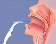 Во время процедуры врач воздействует напрямую на лакуны, направляя на них струю лекарства. Таким образом, гной извлекается. Некоторые медики придерживаются мнения, что процедура не ускоряет выздоровление, она только на время купирует проявления болезни. Но практикующие ЛОР-специалисты утверждают, что после нескольких процедур постепенно восстанавливается функция самоочищения в органе.