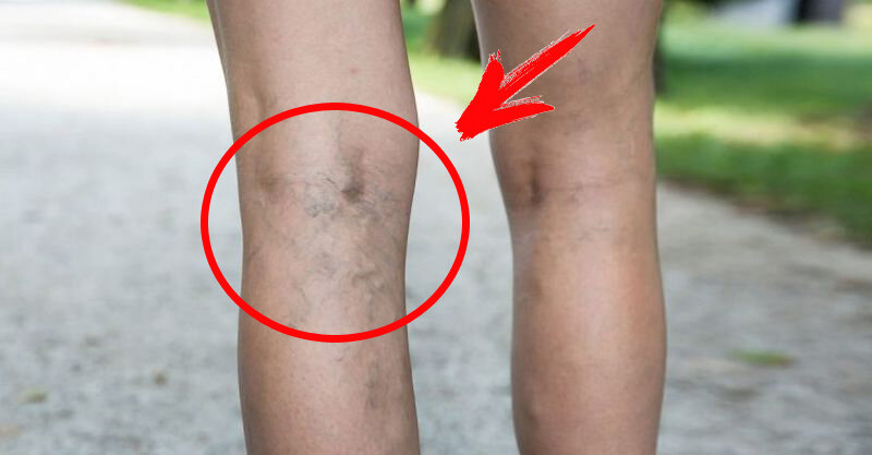 варикоз, лечение варикоза, признаки, симптомы, варикозные расширение вен