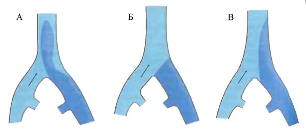 А - флотирующий тромб(имеет свободный подвижный конец). Б - нефлотирующий тромб окклюзирует вену. В - нефлотирующий пристеночный тромб(нарисован неправильно не смотрете на него). Источник изображения -  lektsia.com.
