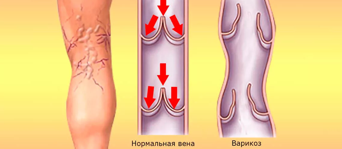 Варикозное вен нижних конечностей