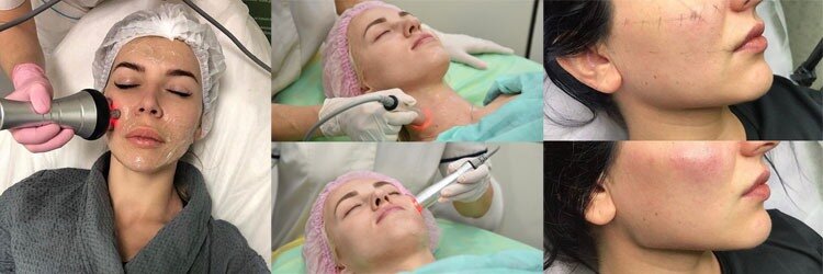 Процедура РФ-лифтинг в Днепре