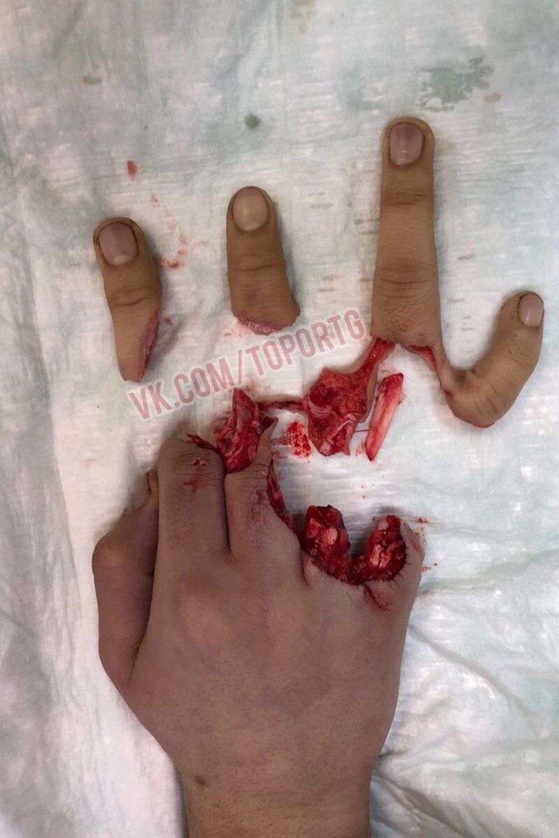 Мужчина менял колесо, и дамкрат  прищемил его пальцы 