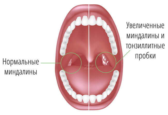Принято считать, что вспышки острых респираторных заболеваний чаще случаются в холодное время. Однако с приходом теплой погоды далеко не все из них перестают быть угрозой. Так, например, ангина встречается чаще как раз весной и летом. Почему так происходит, как распознать болезнь и можно ли ее предотвратить в первые теплые дни, разбирался MedAboutMe.