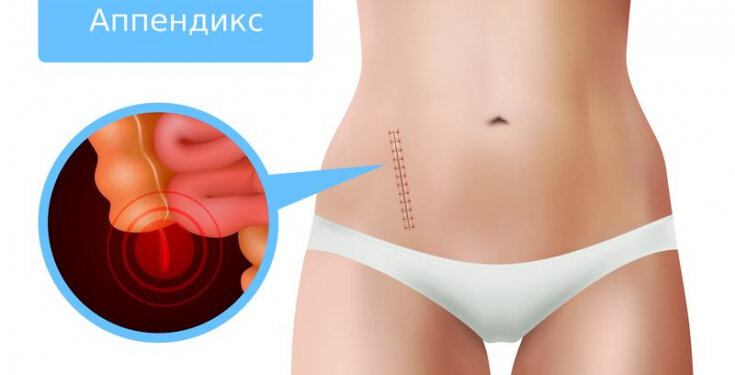 Сколько времени развивается аппендицит. Сколько времени развивается аппендицит