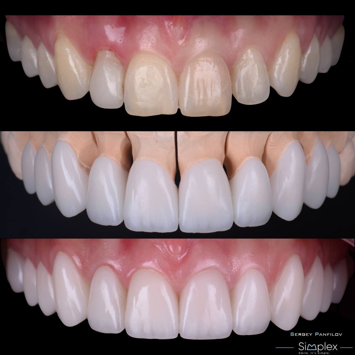 Примеры керамических реставраций