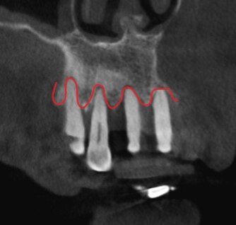 Серьёзная деструкция костной ткани.