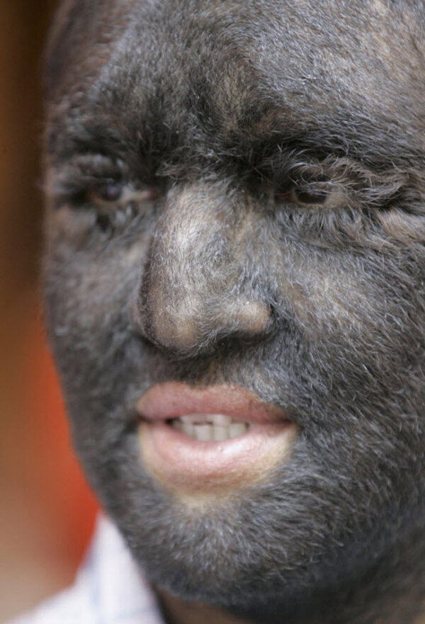 «Человек-оборотень» страдает редким заболеванием под названием генерализованный врожденный гипертрихоз – избыточная волосатость. 