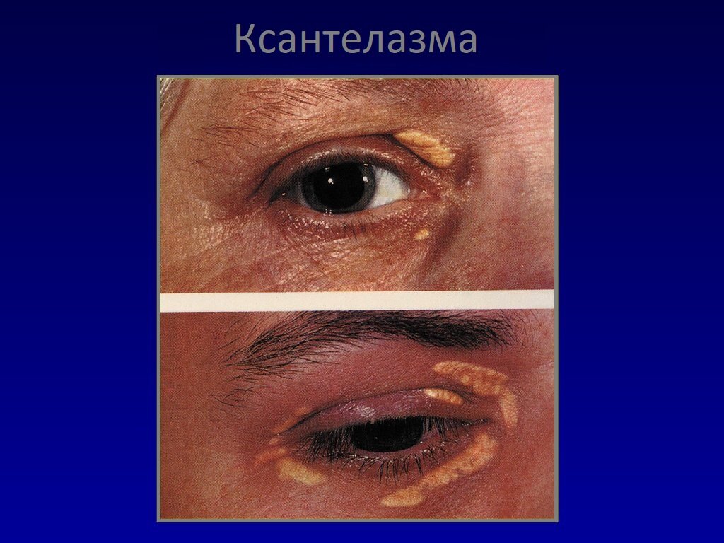 как убрать жировик с глаза