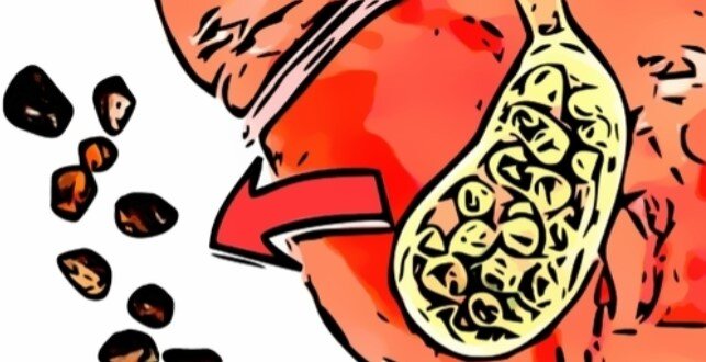 Камни в желчном пузыре