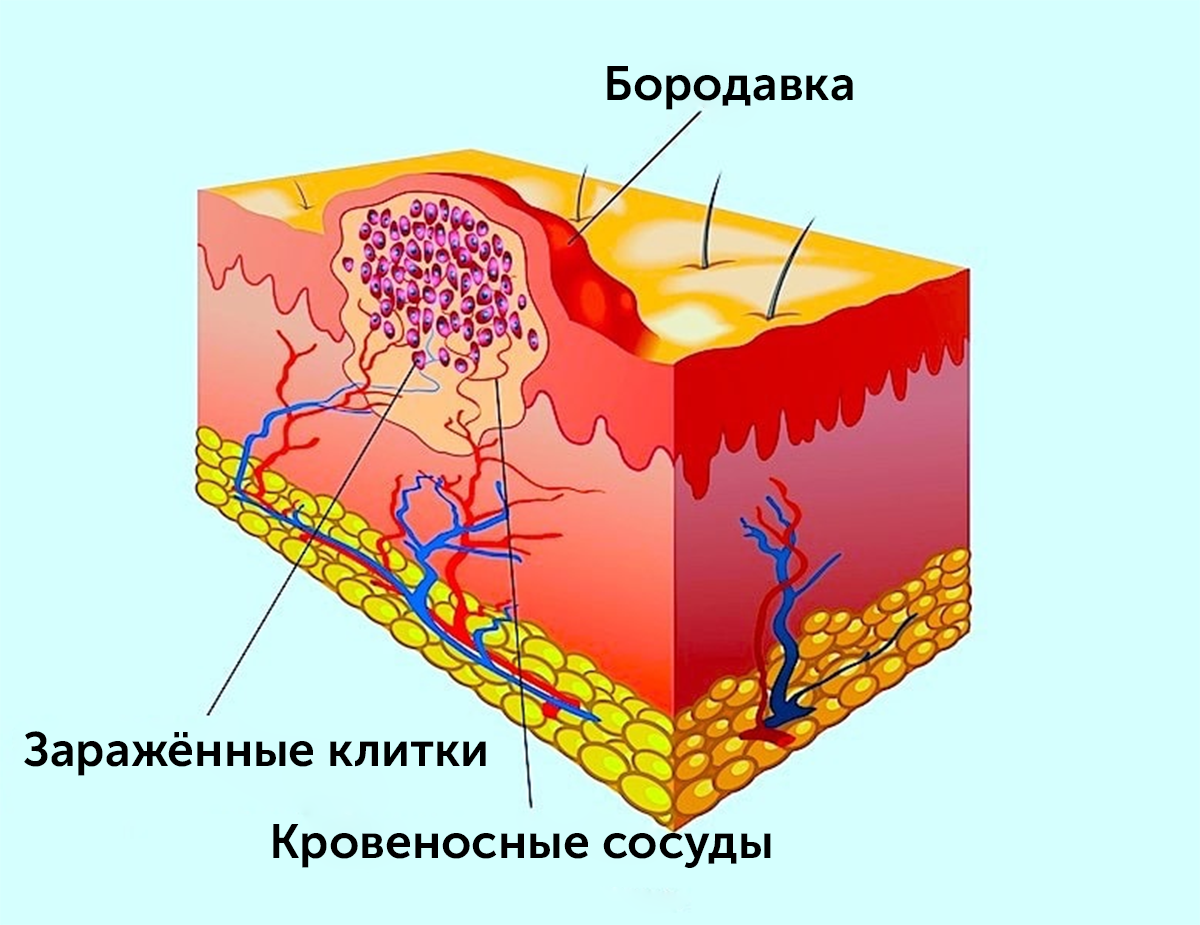 Вирус папилломы опасен? Нужно ли делать прививку | Международная клиника  MEDICA24 | Дзен