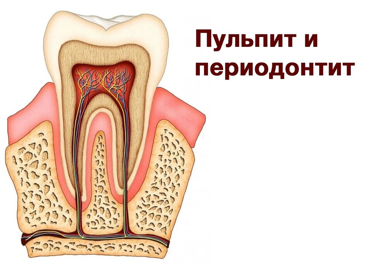 Периодонтит и пульпит разница