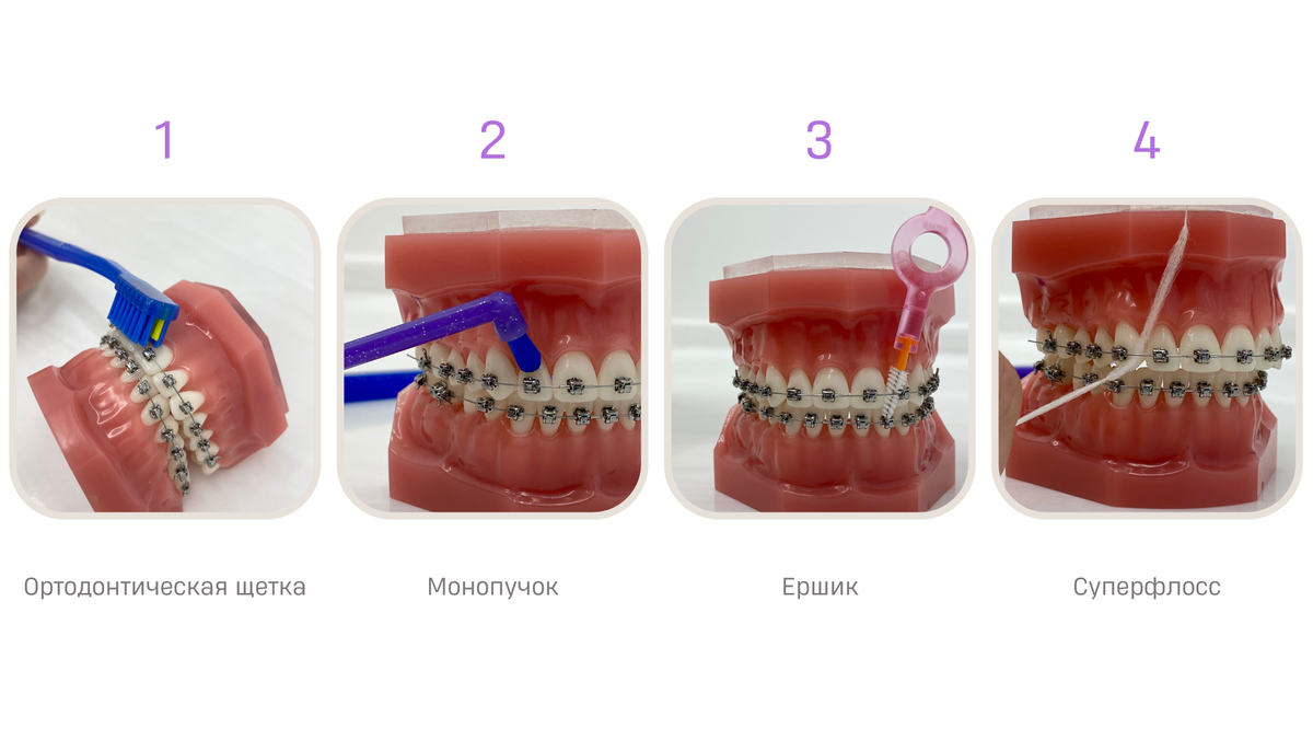 Домашняя гигиена полости рта при лечении на брекетах | Конфиденция —  ортодонтия | Дзен
