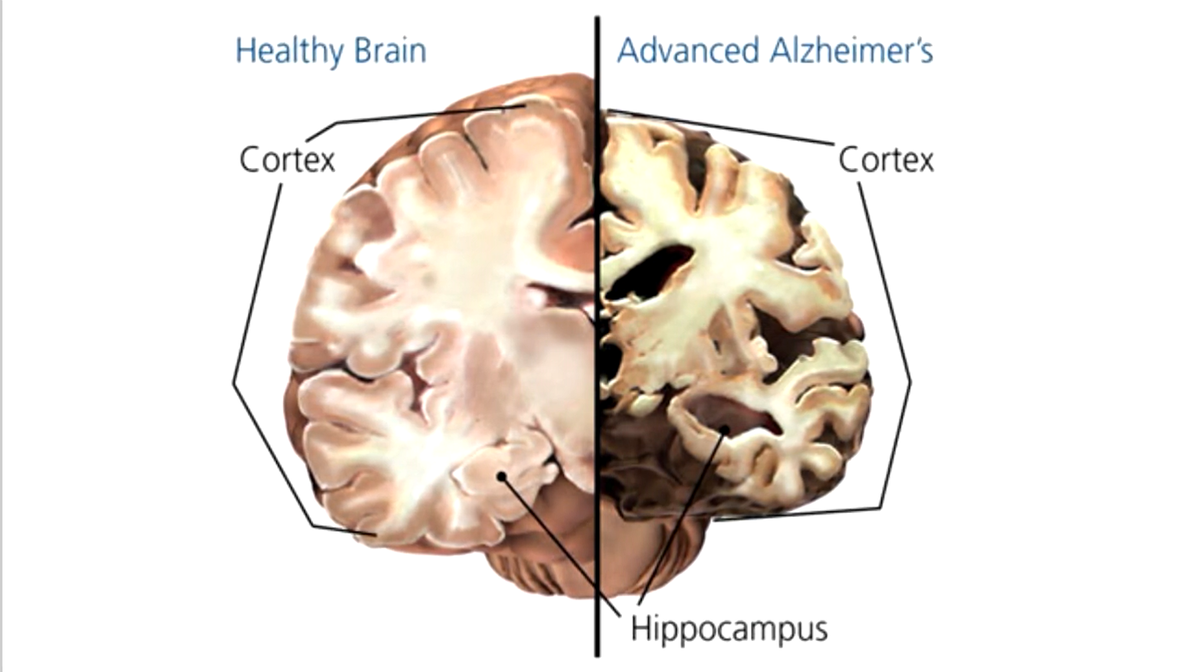 Brain disease. Мозг при болезни Альцгеймера. Поражение мозга при альцгеймере. Мозг человека больного Альцгеймером. Дегенеративные изменения мозга.