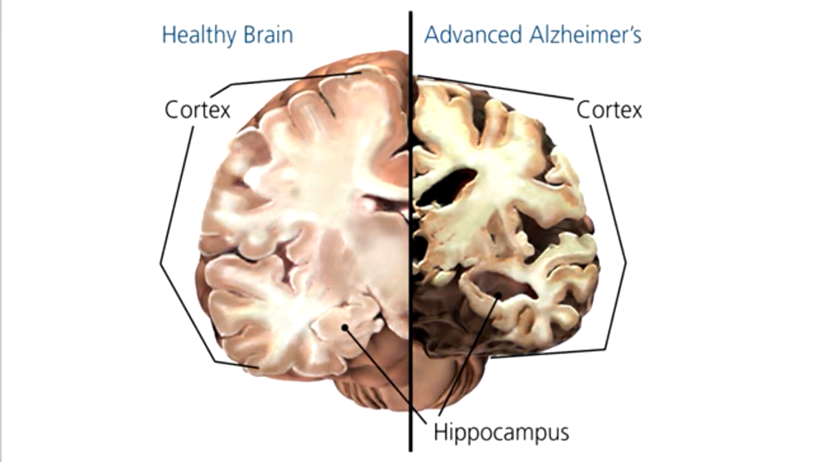 Brain disease