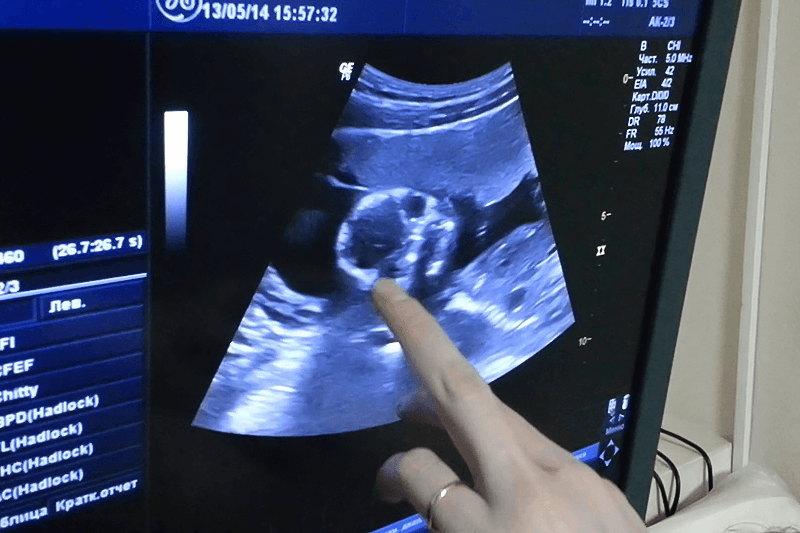 Будет в 44 неделе. Снимок УЗИ. УЗИ ребенка. Снимки УЗИ. УЗИ 18 недель беременности.