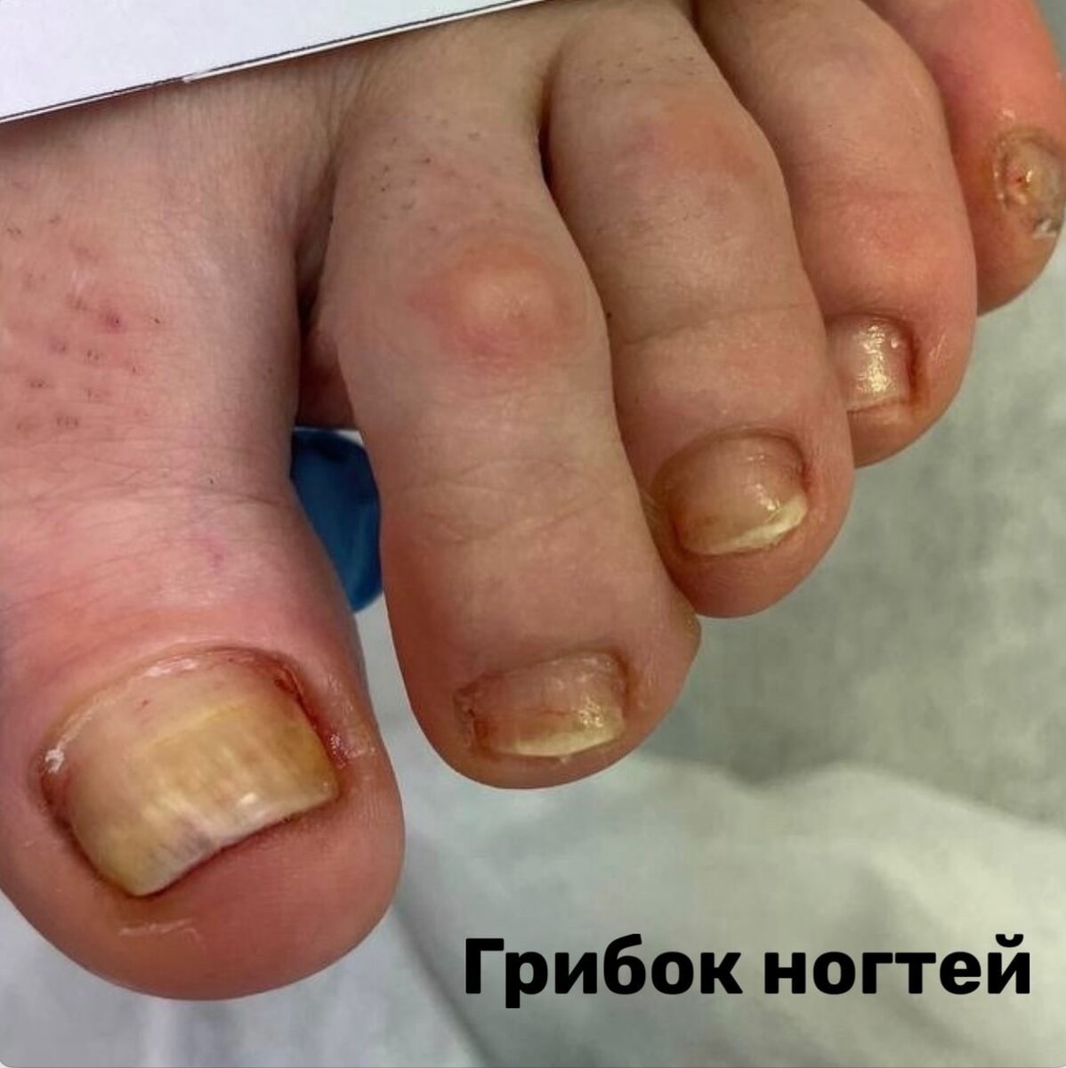 Грибок ногтей относится к распространенным и коварным заболеваниям ...