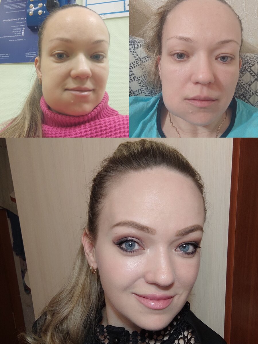 Это я с флюсом. Сделала фото на память. Реально мне было очень плохо, я даже ревела всю дорогу, когда мне нервы удалили. 