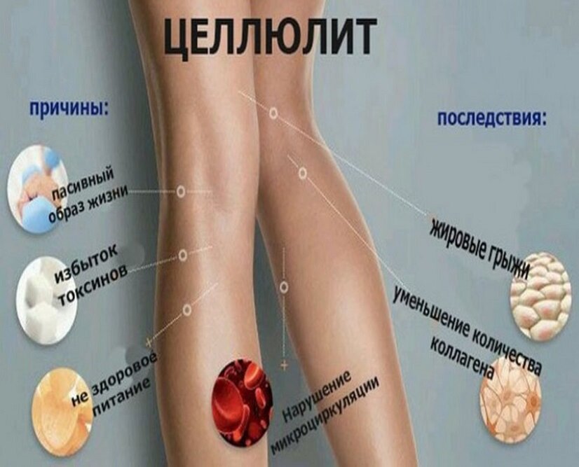 Как сделать обертывание от целлюлита в домашних условиях