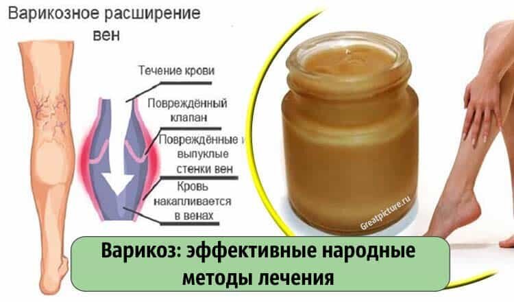 Варикозное расширение вен