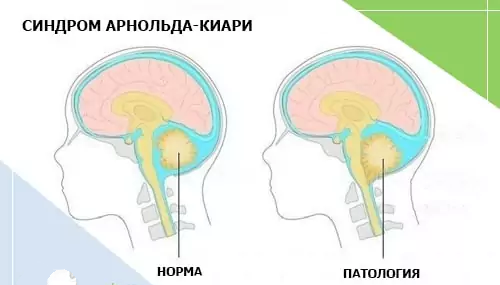 Аномалия арнольда киари простыми словами. Гидроцефалия Арнольда Киари 2. Аномалия Арнольда Киари операция.