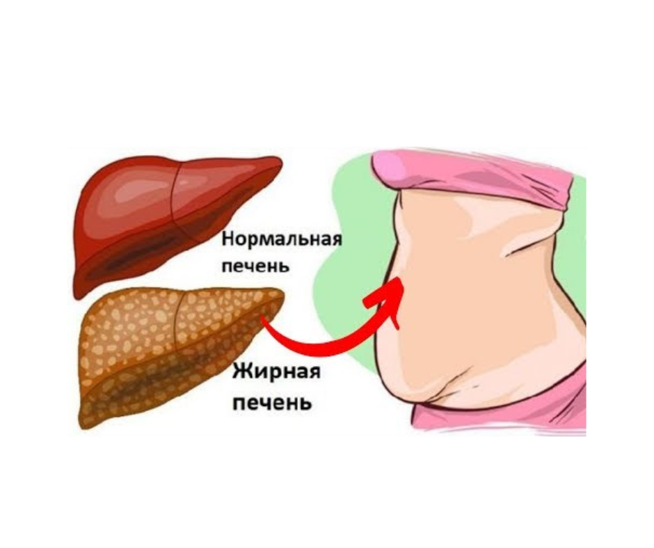 Ожирение печени фото у женщин