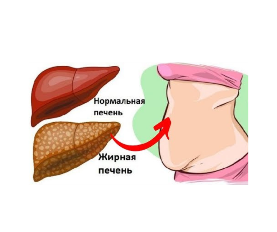 Ожирение печени