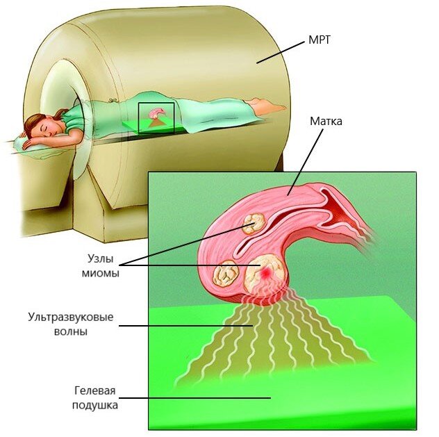 Высокотехнологичное лечение миомы матки без операции