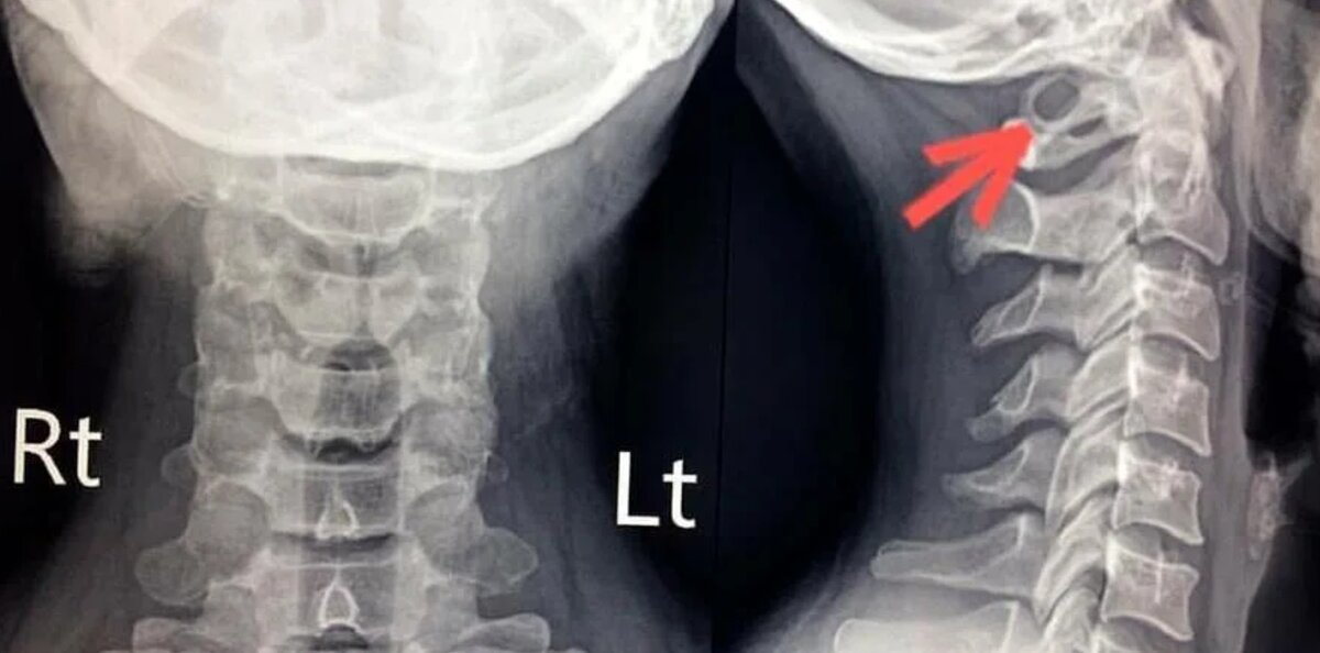 Аномалия шейного отдела позвоночника