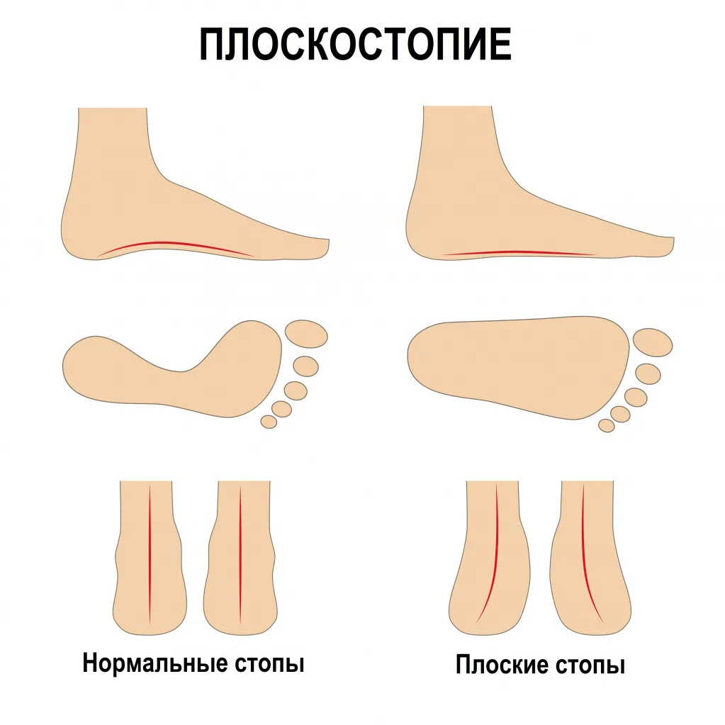 Вывих голеностопного сустава | Блог ММЦ Клиника Научной Медицины Люблино, Москва