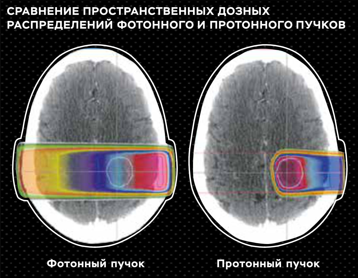 Одним из ключевых преимуществ протонной терапии является ее способность доставлять высокие дозы радиации к раковой ткани с повышенной точностью и аккуратностью. Это связано с уникальными свойствами протонного пучка, которые позволяют ему выделять свою энергию в очень определенном месте. Это не только приводит к меньшему количеству побочных эффектов, но и снижает риск долговременного повреждения здоровых тканей пациента