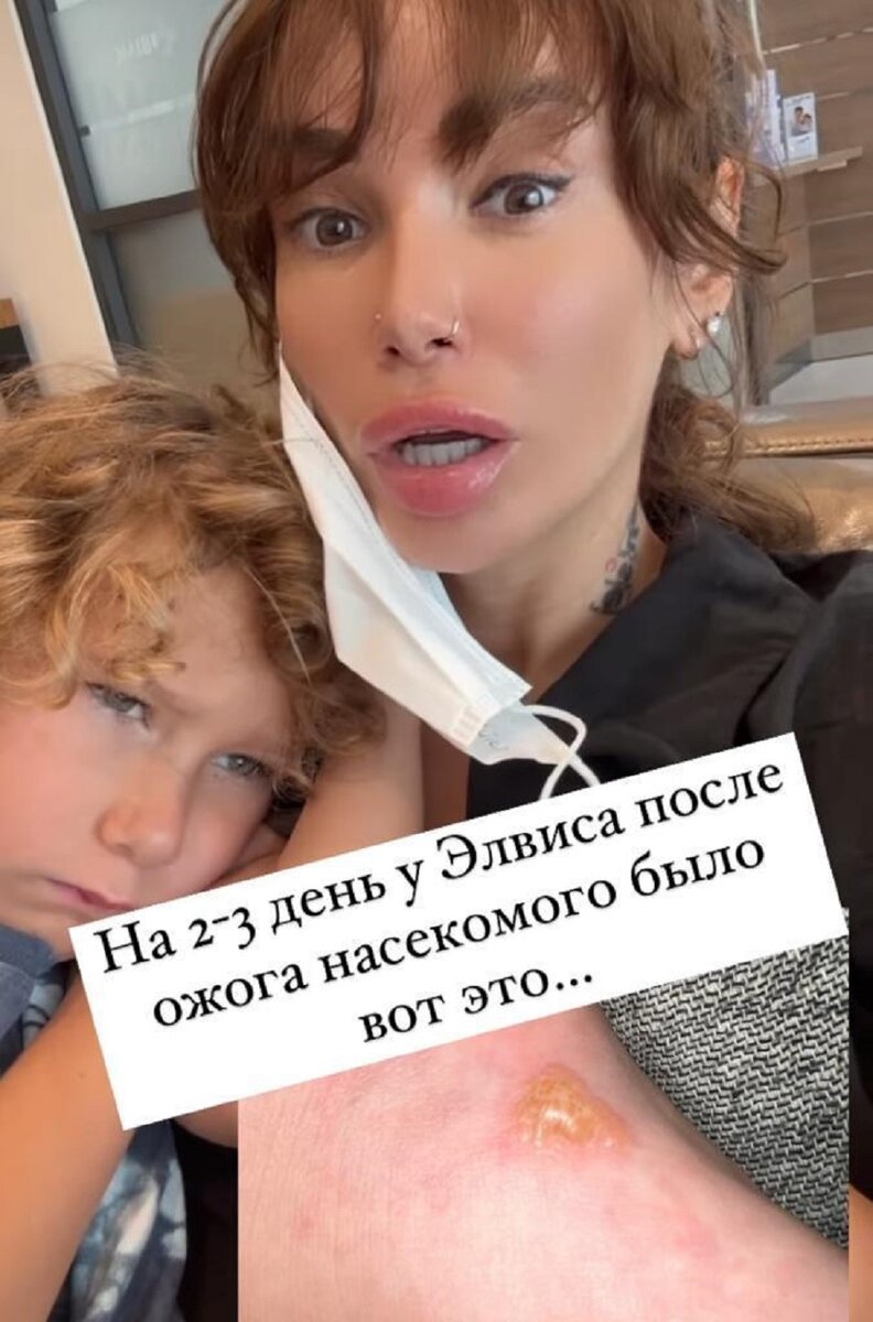    Айза Долматова обратилась к медикам после того, как ее сына ужалило насекомоеСоцсети Айзы Долматовой