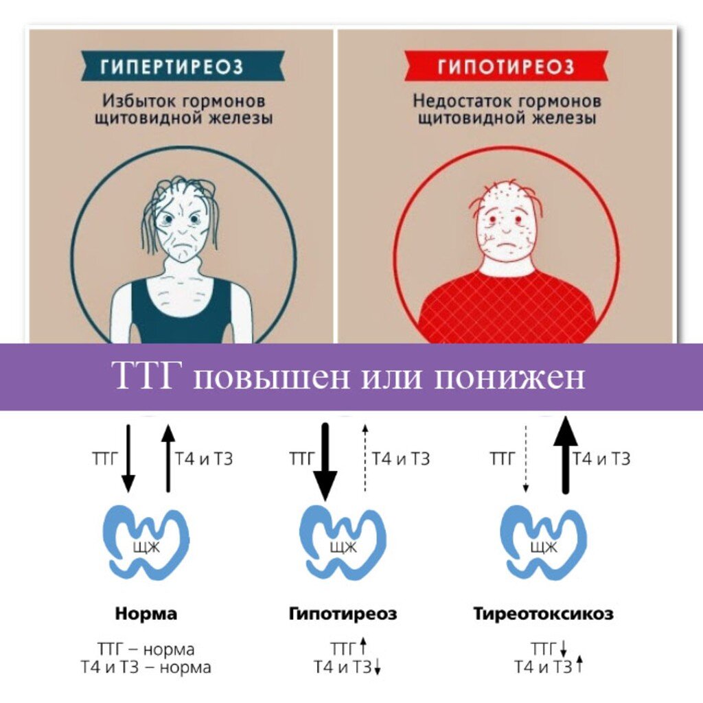 Тиреотоксикоз - гормональный пожар | Деревенский доктор | Дзен