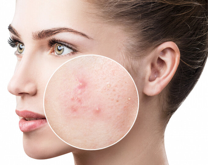 Себорея. Acne vulgaris