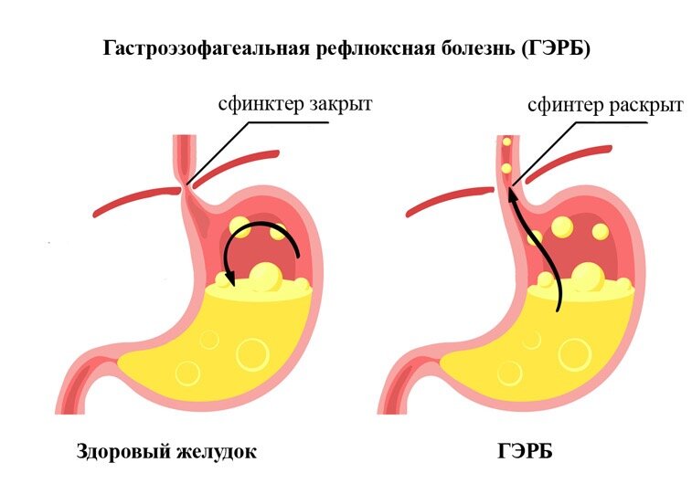 Постоянно изжога после еды что делать. Постоянно изжога после еды что делать. Передвижение пищи по пищеводу. Постоянно изжога после еды что делать. Постоянно изжога после еды что делать.