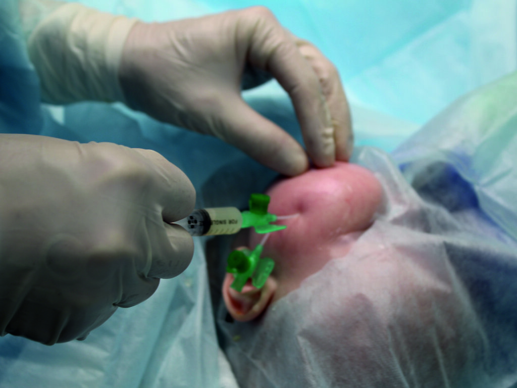 Фото материал Центра сосудистой патологии ГЕМАНГИОМА