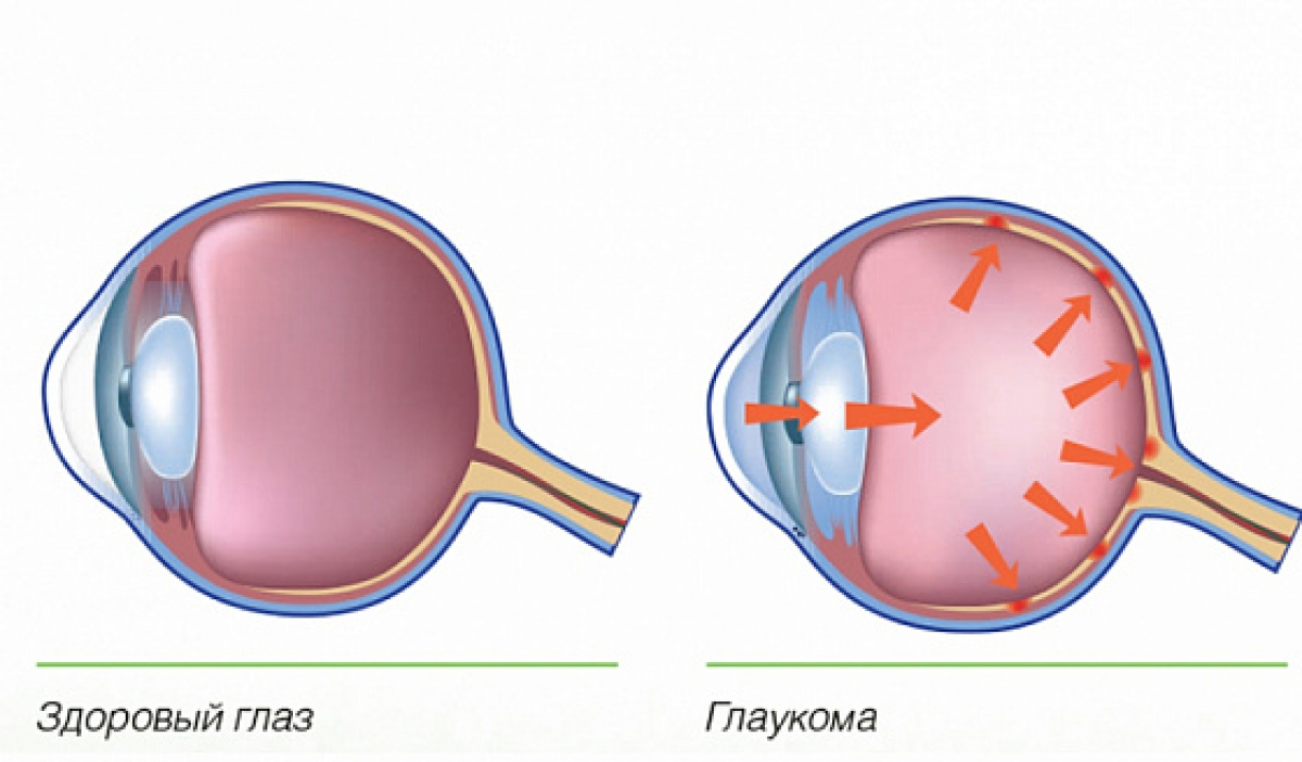 Глазное давление при катаракте. Здоровый глаз и глаукома.
