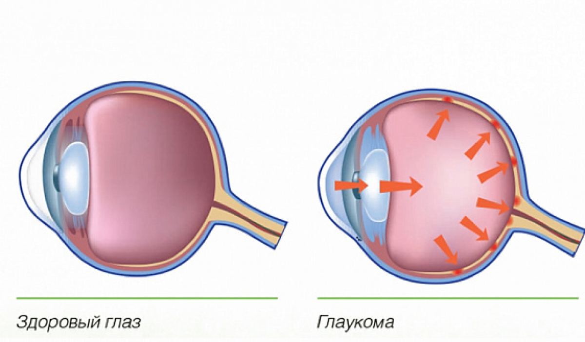 Глазное давление симптомы. Глаукома и здоровый глаз. Глаукома схема.