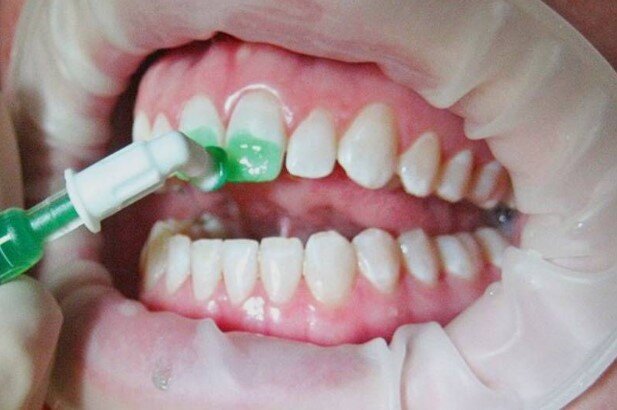 🔎 Коротко Это метод лечения кариеса «без сверления» и установки пломбы. Зуб обрабатывают специальным препаратом, который тормозит разрастание кариозной полости.